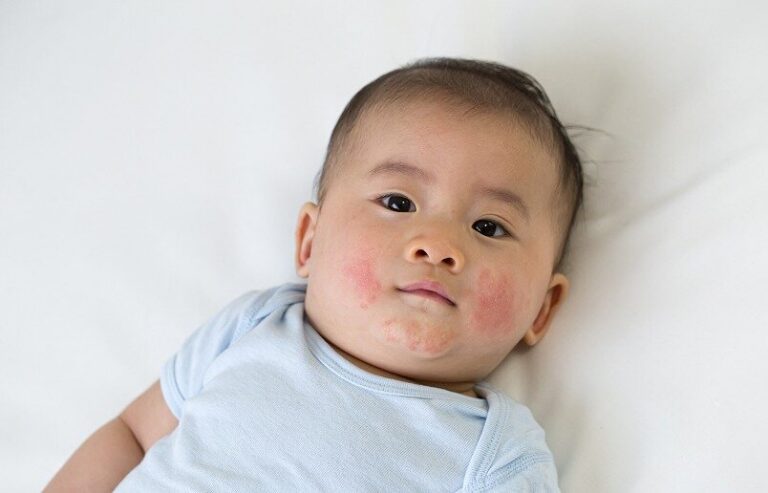 Cow's milk protein allergy